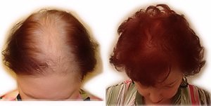 Finalmente, recarga de fibra de cabelo de cabelo 250 gramas 8,82 onças para a perda de cabelo, que oculta o recarga adequada para finalmente o cabelo, o nanogênio do Toppik Xfusion Strand Bosley finalmente