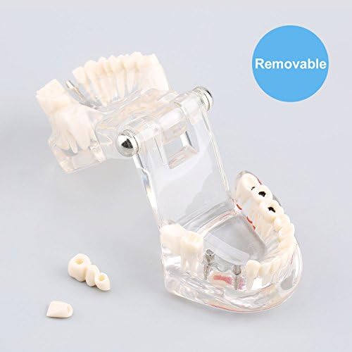 Modelo odontológico destacável, modelo transparente de ensino dentista dentista de dente