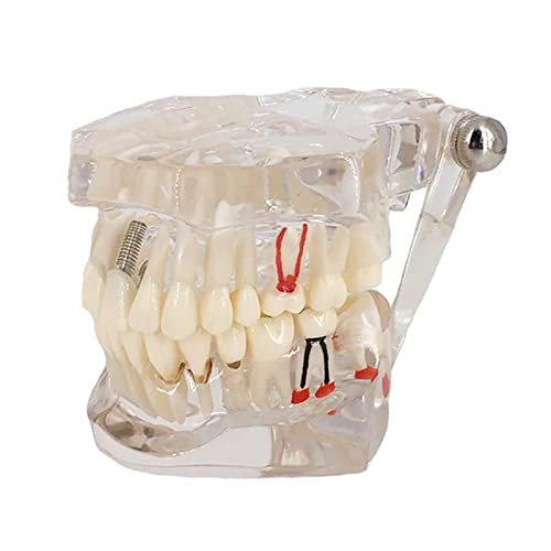 Modelo de dentes de doença transparente, youya dental transparente dentes de implante dental modelo